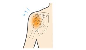 Shoulder Dislocation Rehab: Road to Recovery and Return to Sport- A Physio Perspective